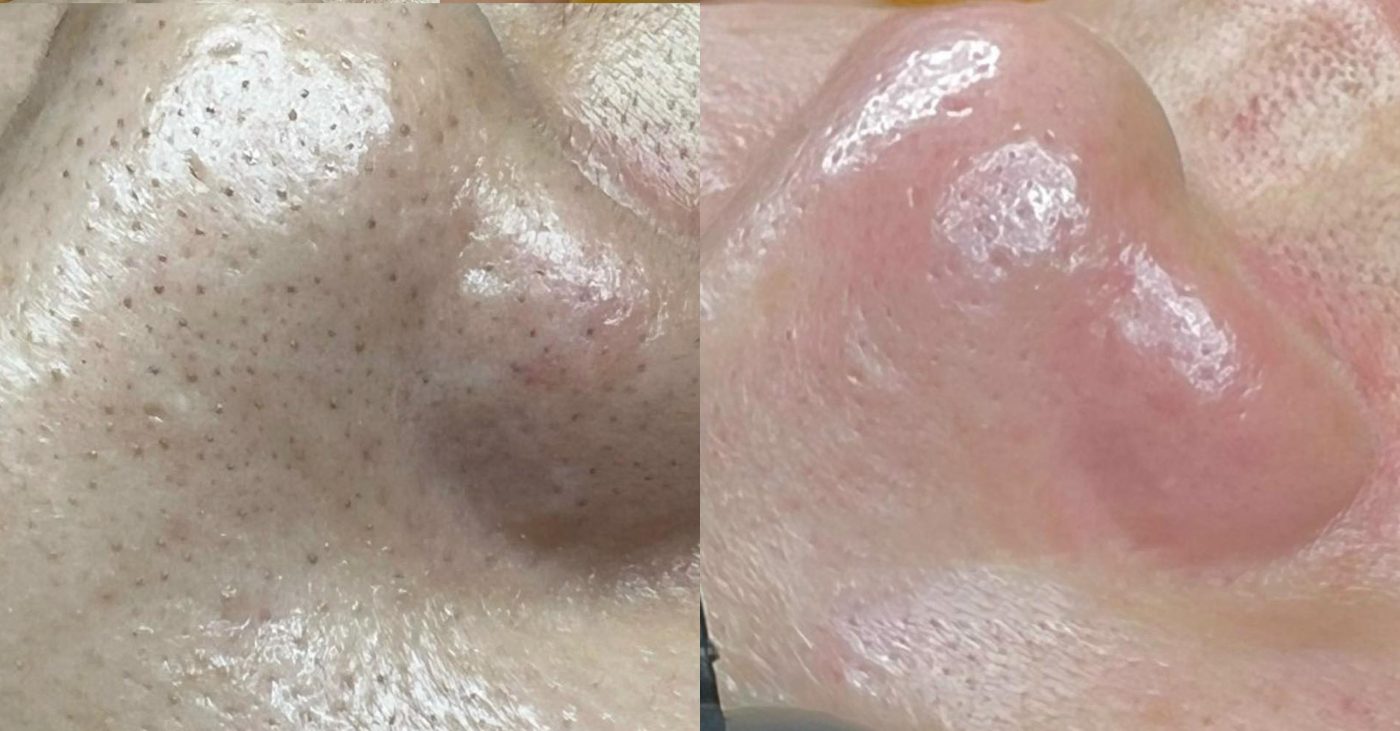 Làm thế nào để loại bỏ sợi bã nhờn ở mũi một cách hiệu quả 1