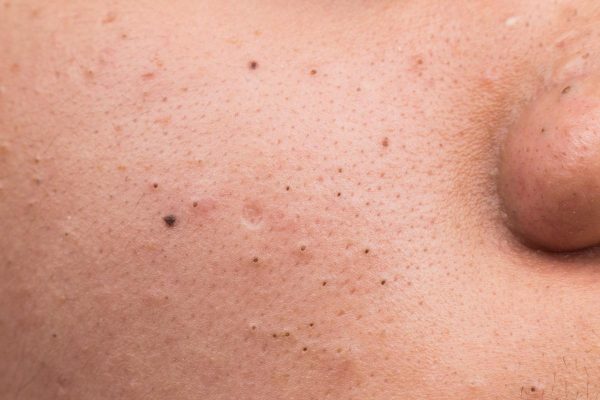 Mụn đầu đen: Tại sao lại xuất hiện và cách để ngăn chặn chúng?