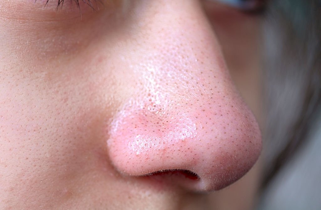 Mụn đầu đen ở mũi: Nguyên nhân và 7 cách điều trị hiệu quả