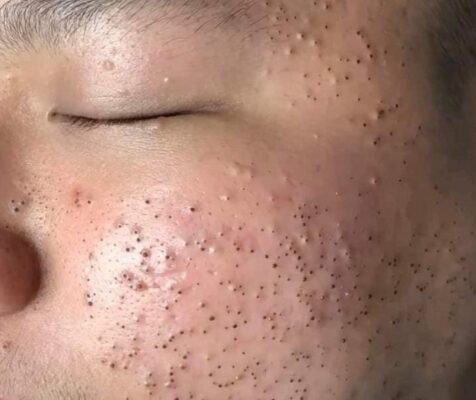 Trị mụn đầu đen với 10 phương pháp tự nhiên và an toàn