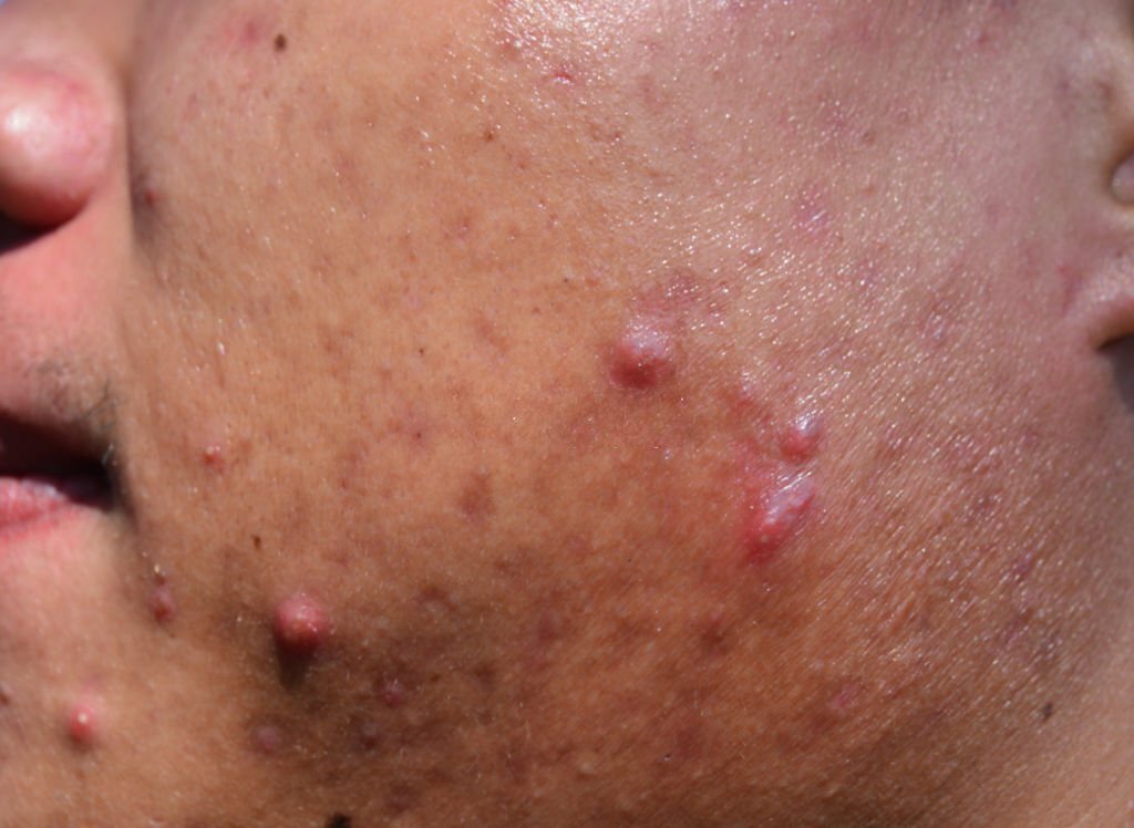 Mụn bọc: Nguyên nhân, triệu chứng và cách điều trị 1