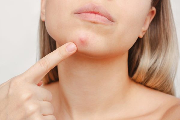 Tìm hiểu nguyên nhân gây ra mụn bọc ở cằm và cách điều trị hiệu quả