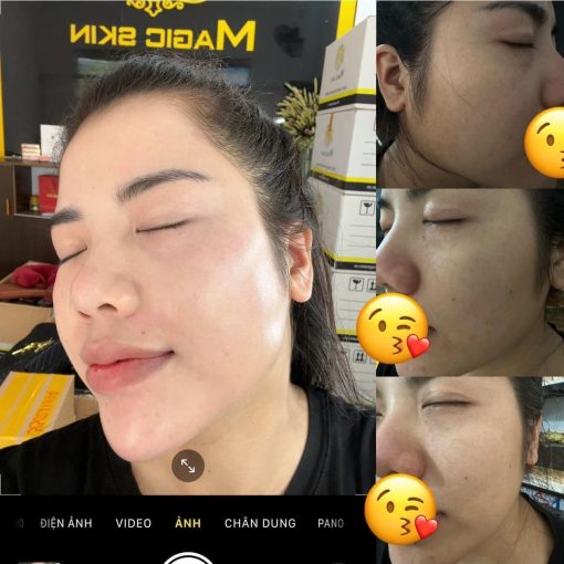 Melas Detox Peel ( Detox nám ) - Ảnh 7